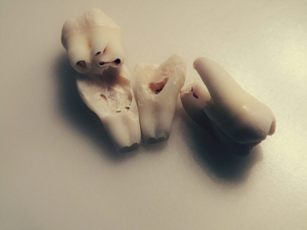 lost tooth