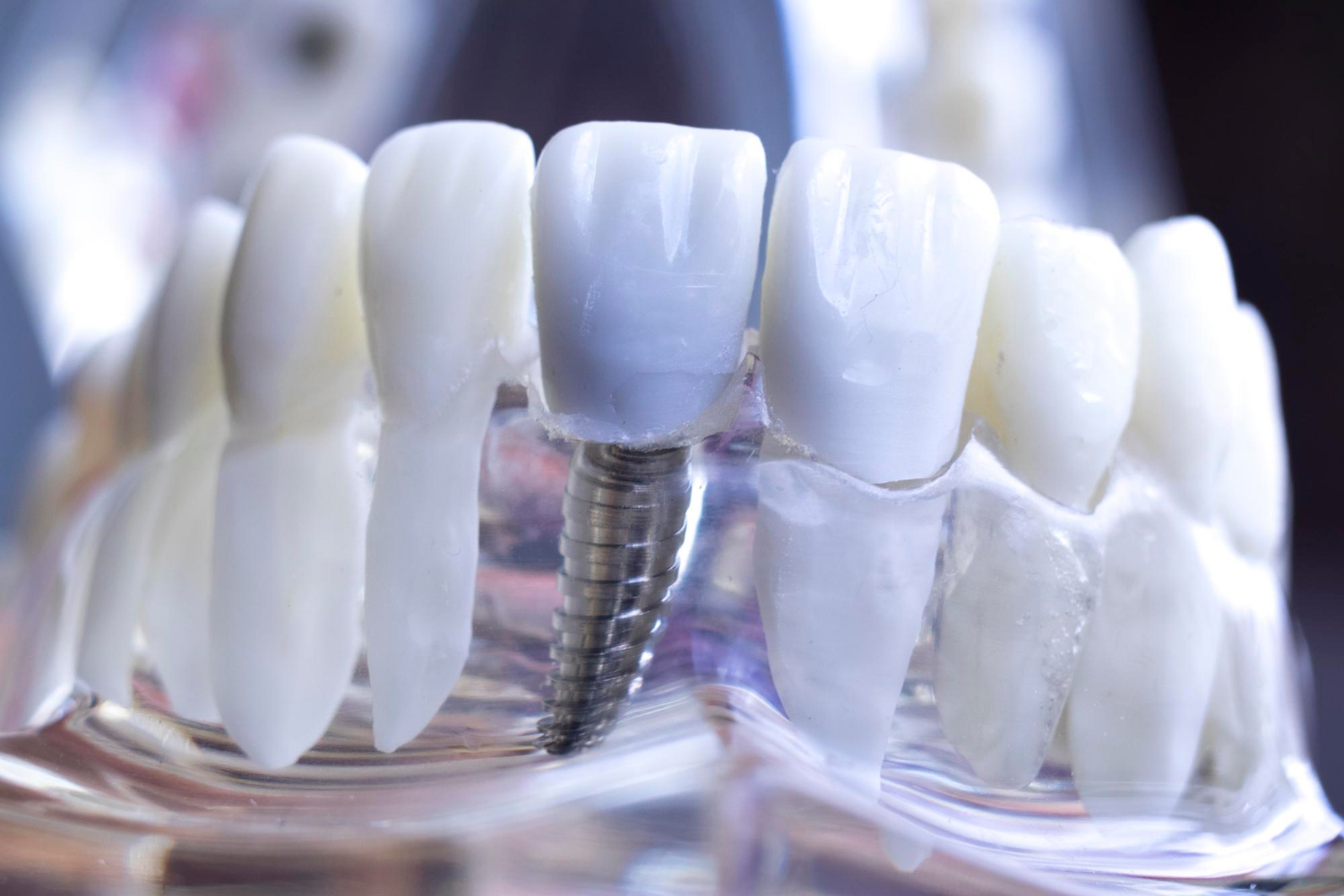 implant 1