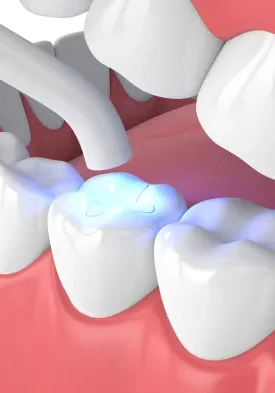 fillings