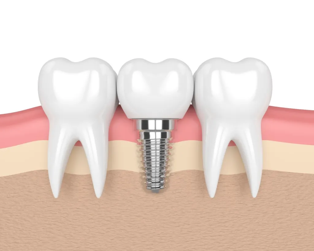 dental implants are metallic posts that act as foundations for replacement teeth