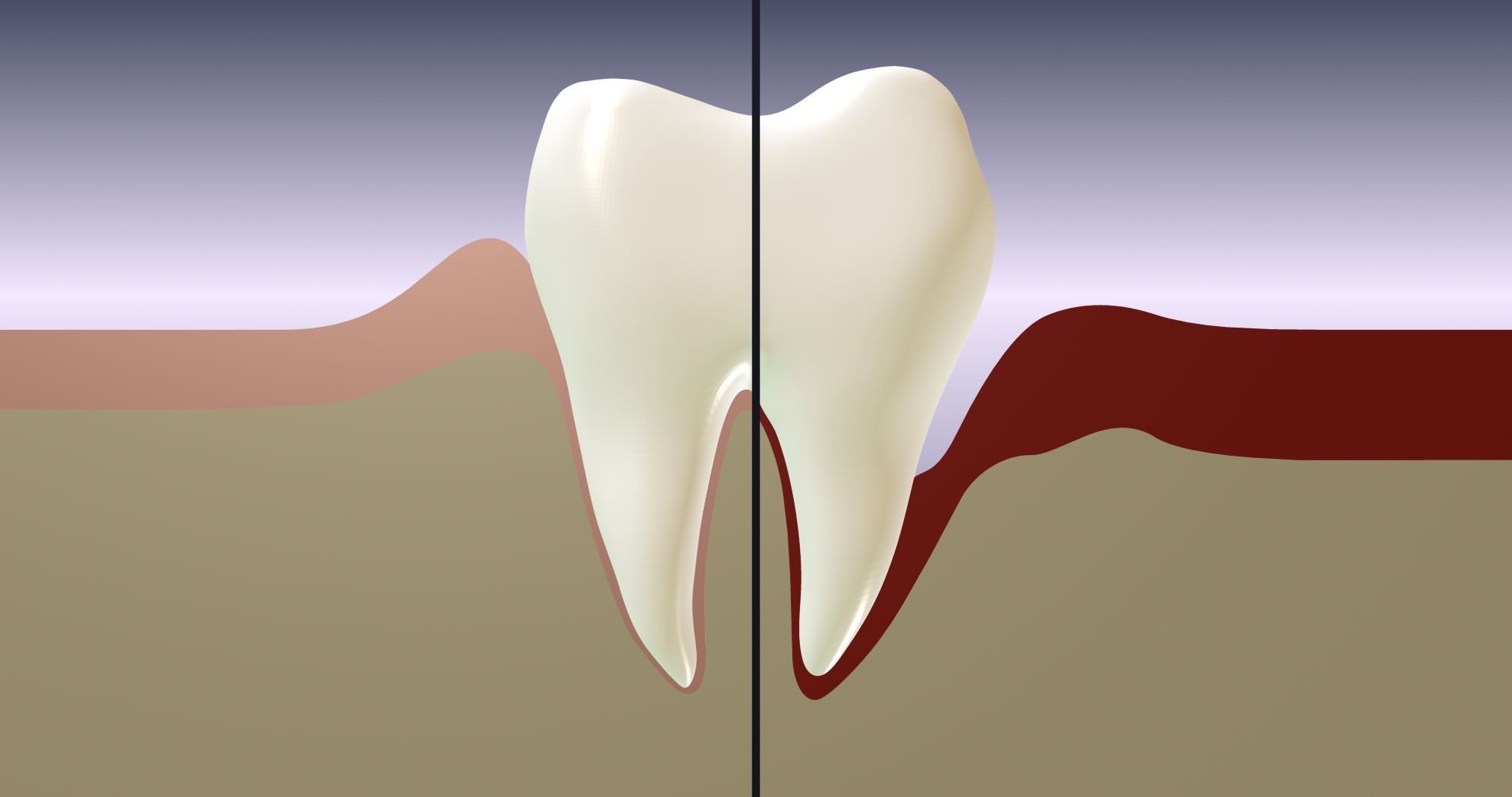 deep teeth cleaning may be needed to treat or maintain gum recession
